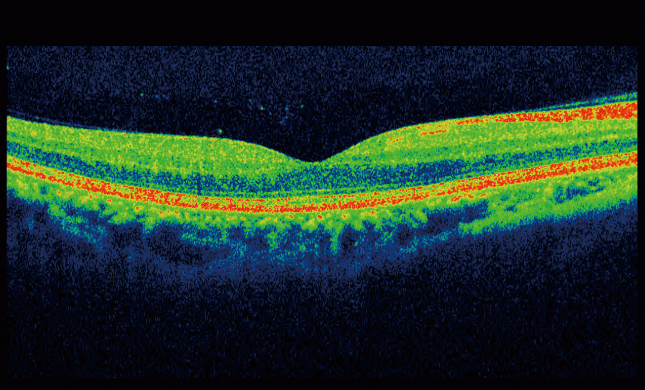 Image of Optical Coherence Tomography scan healthy macula