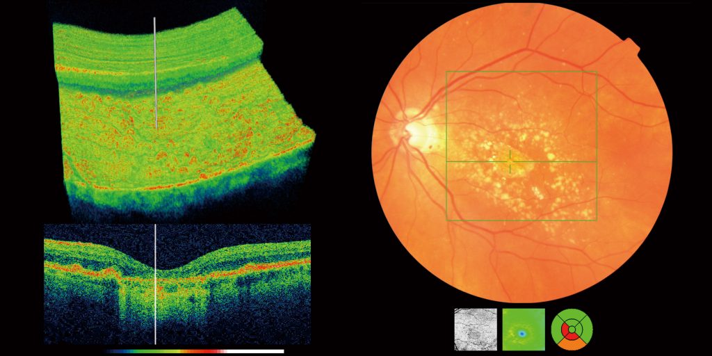 image of OCT scan of age related macula disease