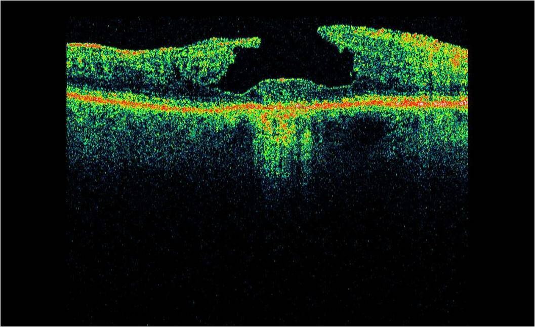 Image of a Optical Coherence Tomography scan lamelar macula hole
