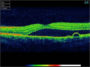 OCT scan showing sub retinal fluis