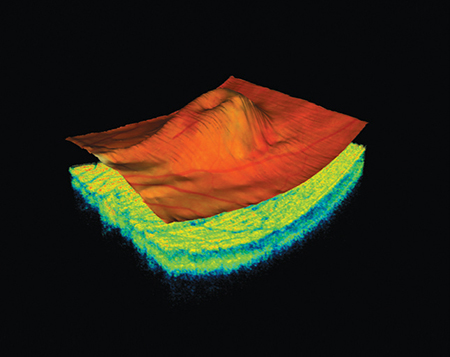 image of colour optical coherence tomographer OCT scan of swollen macula