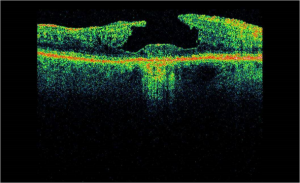 OCT scan showing a lamelar macula hole