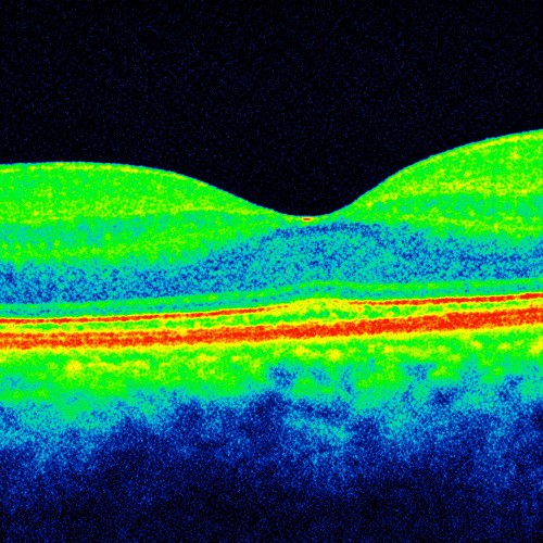 OCT scan 2 Macula OCT scan