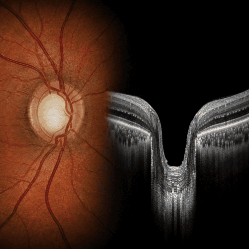 A glaucomatous optic disc