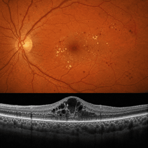 a portrayal of diabetic eye disease