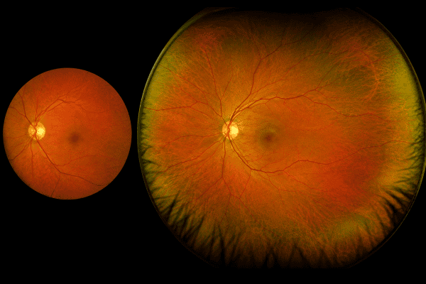 comparison of optos and a standard fundus photo